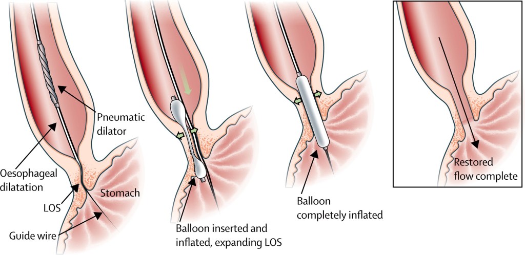 Esophageal balloon dilation