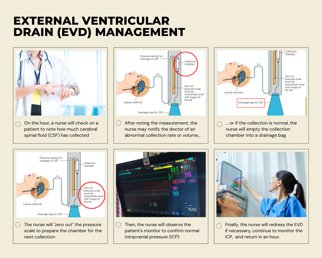External Ventricular Drain (EVD) Management Storyboard - depicts the process of EVD monitoring and management by nurses in the neurosurgical intensive care unit.