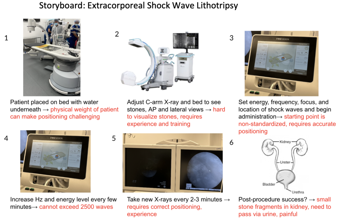 A series of 6 photos and accompanying text illustrating each step of a extracorporeal shockwave lithotripsy procedure.