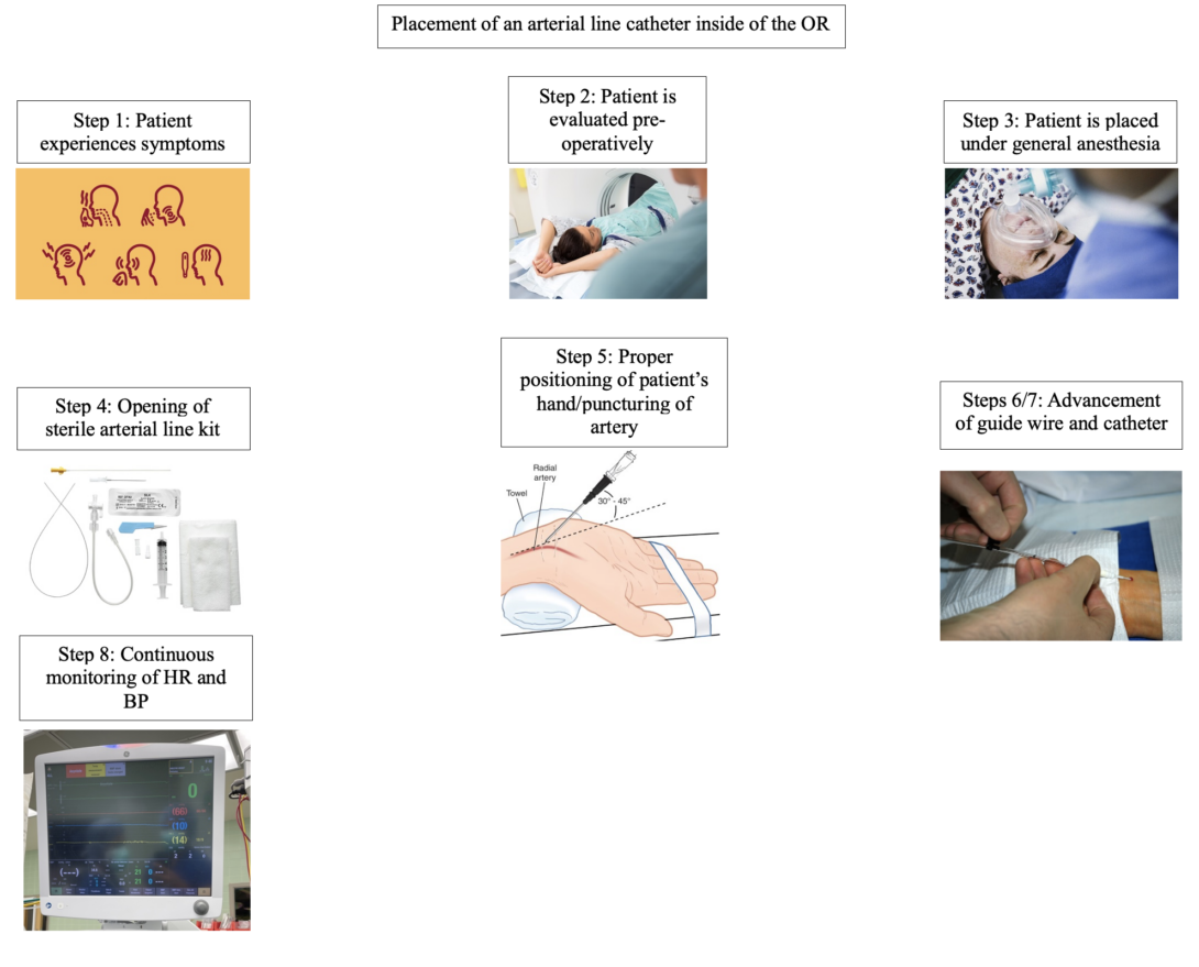 A storyboard which shows the different steps involved in the placement of an arterial line catheter into a patient inside of an operating room.