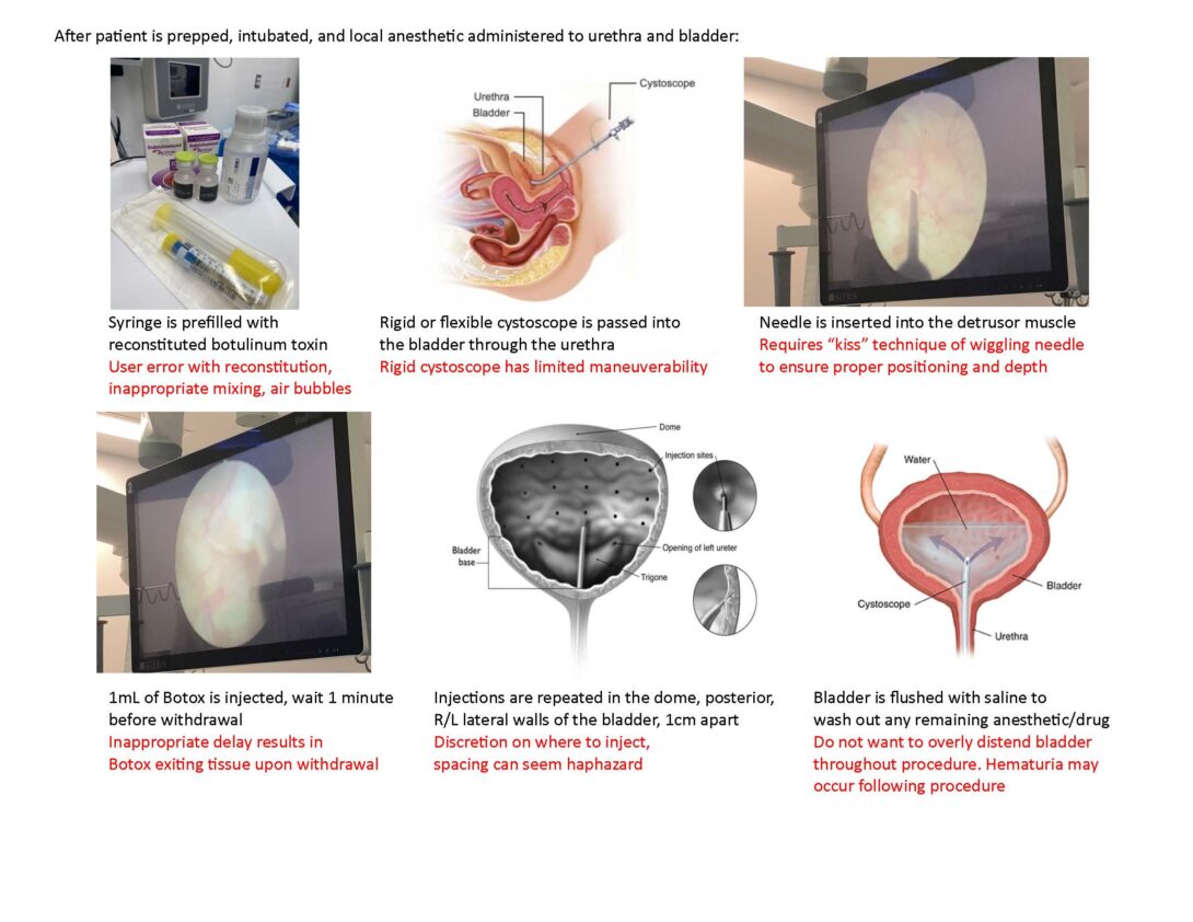 Step-by-step storyboard of cystourethroscopy with botulinum toxin injection, with described pain points