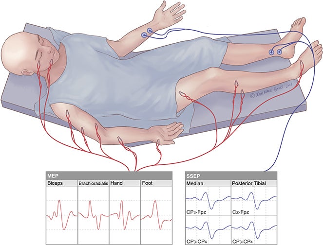 Neuromonitoring Modalities