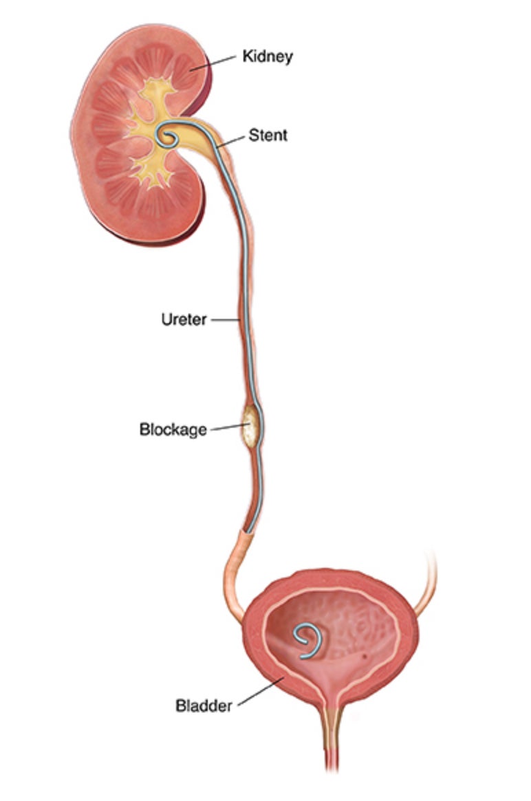 Current ureteral stent design has two curls, to help maintain the stent in position