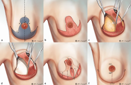 The image shows a drawing of the steps involved in a breast reduction (nipple-sparing) surgery.