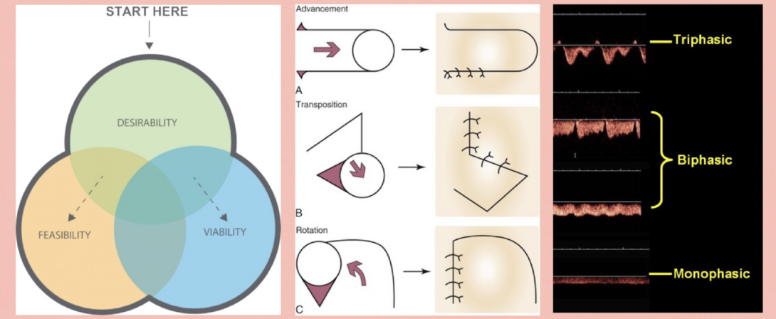 Left to right: IDEO framework, flap planning, doppler waveforms